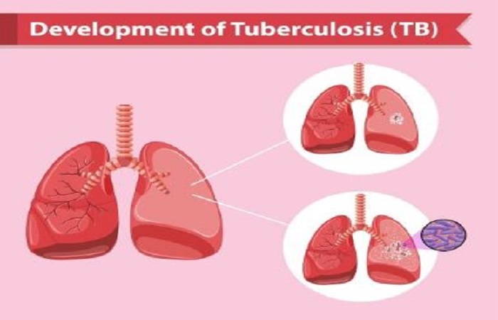Tuberculosis new challenges
